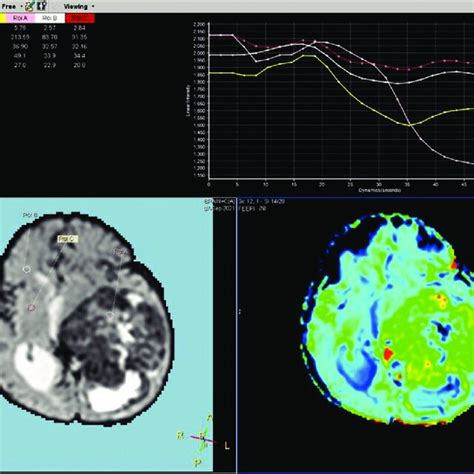 Mri Brain Perfusion Image Showing Excessive Vascularity Of The Tumor