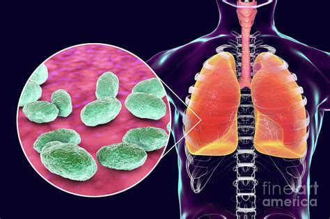 Pneumonia Caused By Haemophilus Influenzae Bacteria 1 By Kateryna Konscience Photo Library