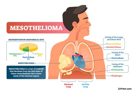 The Dangers Of Asbestos Everything You Need To Know