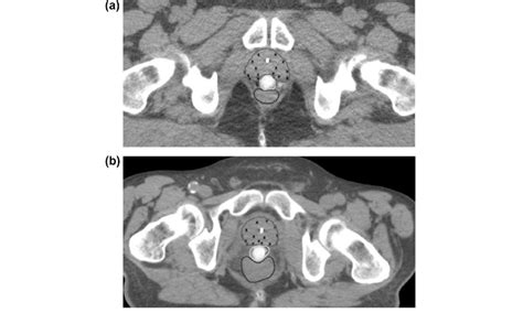 Hdr Brachytherapy Treatment Planning Ct Scan Showing The Prostate