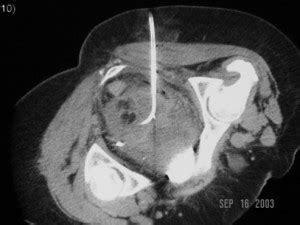 CT Guided Percutaneous Drainage Of A Deep Pelvic Abscess Ken U