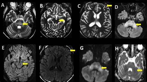 Subacute Sclerosing Panencephalitis PSP Causes Symptoms And Treatment