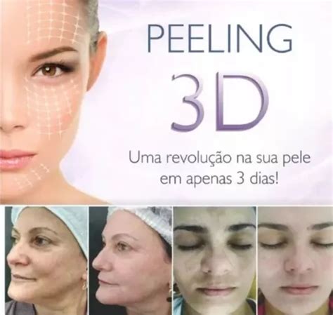 Peeling D Cido Retino Co Ml Cido Tca Ata Parcelamento