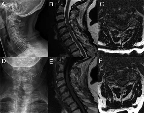 Uncovertebral Joint Hypertrophy Mri