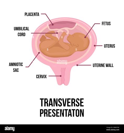 Presentación Transversal Del Bebé Posiciones Incorrectas Del Bebé En El útero Durante El