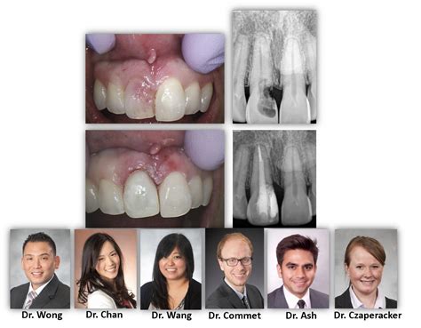 MASSIVE TOOTH RESORPTION | Renovo Endodontic Studio