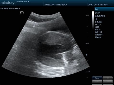 Transabdominal Sonography Showing Uterus With Hematometra And Cervical