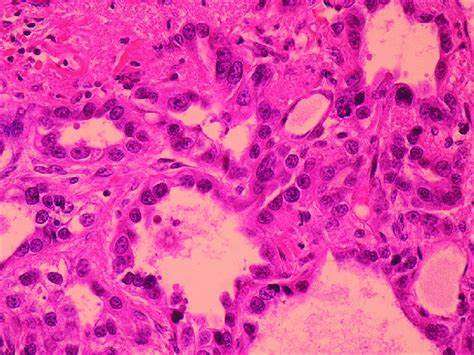 Tumor Cells With Hyperchromatic And Pleomorphic Nuclei And Conspicuous