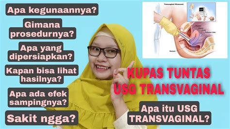 Sharing Pengalaman Usg Transvaginal Kupas Tuntas Usg Transvaginal