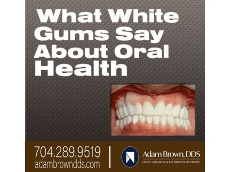 What Do White Gums Say About Oral Health? - Adam Brown Dentistry ...