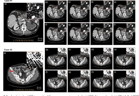 Figure 2 From Attention Based Dual Branch Deep Network For Sparse View Computed Tomography Image