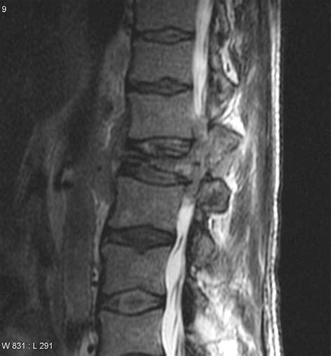 Lymphoma Radiology Reference Article