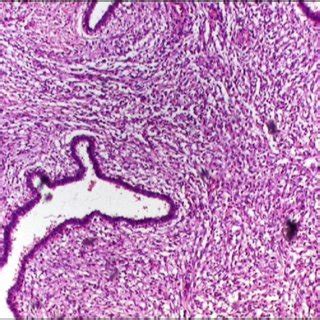 Photomicrograph Showing A Borderline Phyllodes Tumor H E X400