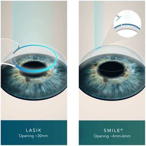 SMILE Eye Surgery NYC Cohen Eye Institute