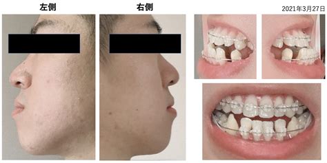 歯列矯正を1年間やった経過と歯並びの変化｜大人の受け口は外科手術なしで治せるのか Tatsu04aのインドネシア生活ブログ