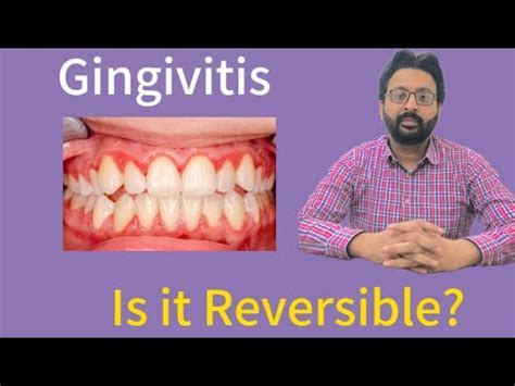 Gingivitis A Gum Disease Can It Be Reversed