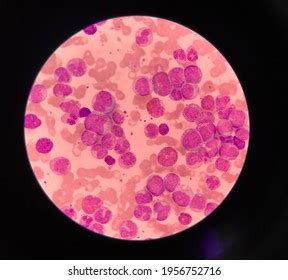 Blood Smear Showing Under Microscopeleukemia Cancer Stock Photo