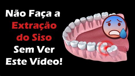 Extração de Siso 3 Coisas Para Fazer Que Deixam a Cirurgia Mais