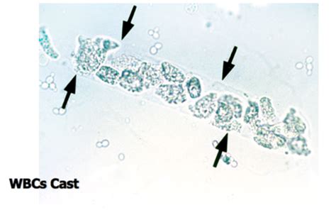 Lecture Urinalysis And Csf Flashcards Quizlet