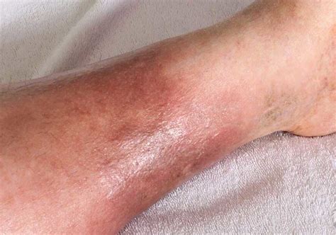 Cellulitis Of The Foot Treatment