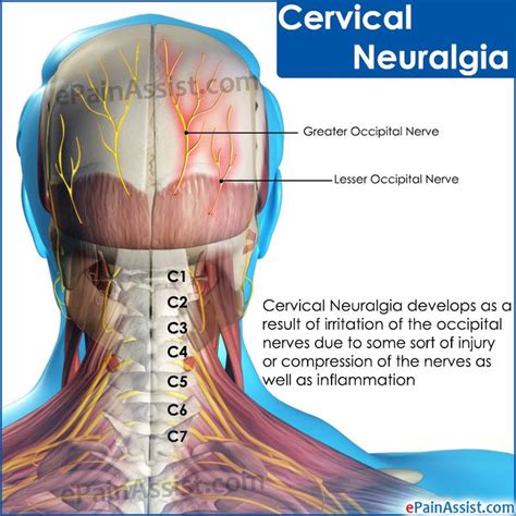 Cervical Neuralgia Cervical Neuralgia Neuralgia Cervical