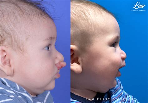 Cleft Lip Repair Primary Bilateral Before And After Photos Sage