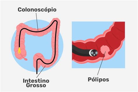 Vai Fazer Colonoscopia Saiba Como Se Preparar Para O Exame