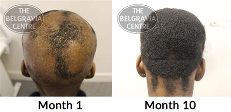 Minoxidil As A Treatment For Alopecia Areata