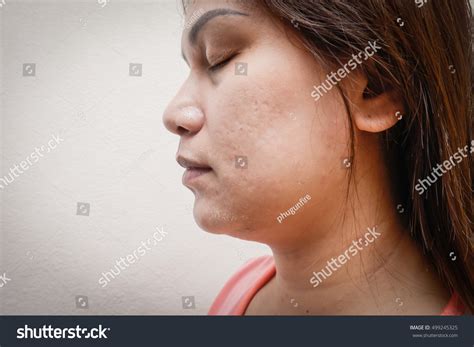 Human Skin Presenting Allergic Reaction Allergic Stock Photo Edit Now