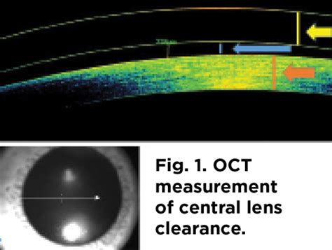 A Coherent Strategy For Fitting Scleral Lenses