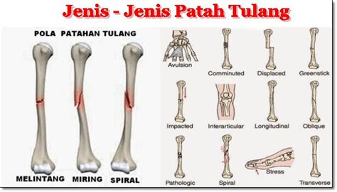 Jenis Patah Tulang