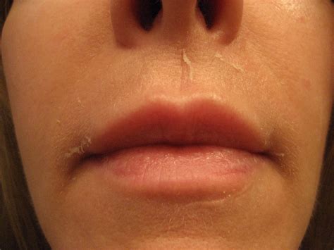 Chemical Peels for Acne and Anti Aging: Above Lip Vertical Lines - the ...