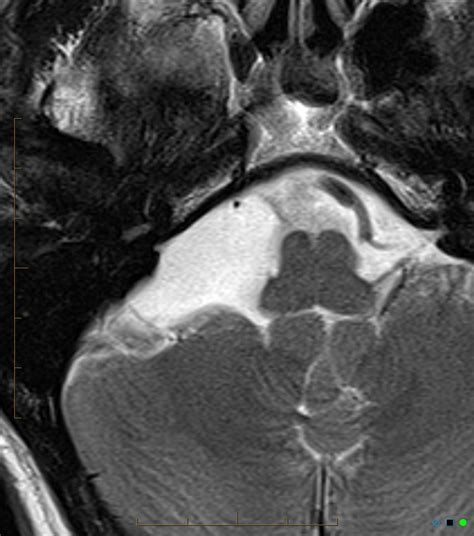 Arachnoid Cyst Cerebellopontine Angle Image Radiopaedia Org