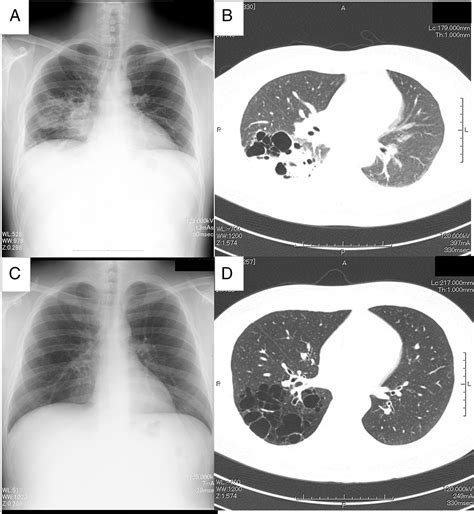 Congenital Cystic Adenomatoid Malformation In Adults Detected After Infection Kagawa 2018