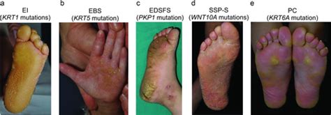 Palmoplantar Keratodermas Clinical And Genetic Aspects Has 2016