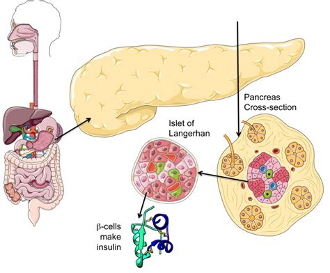 Pdb 101 Global Health Diabetes Mellitus About What Is Diabetes