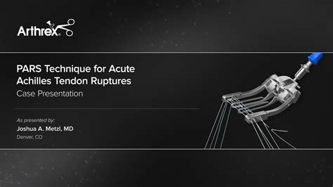 Arthrex Pars Technique For Acute Achilles Tendon Ruptures