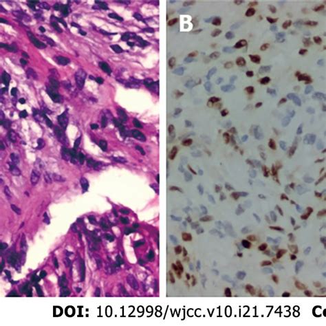 Postoperative Histopathology A Hematoxylin And Eosin Staining