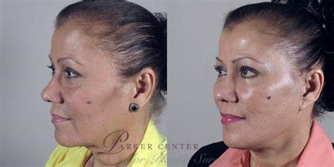 Facelift Before And After Pictures Case 19 Paramus New Jersey Parker Center For Plastic Surgery