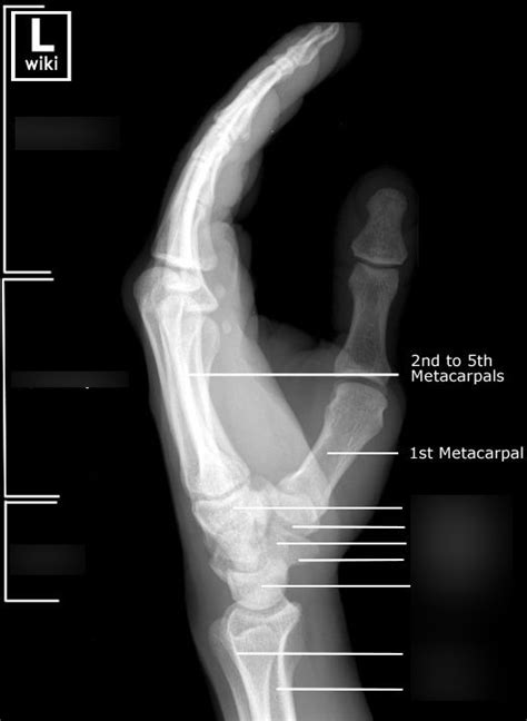 Lateral Hand Xray Diagram Quizlet