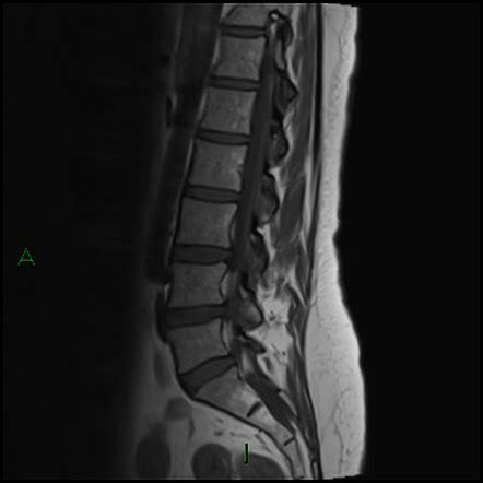 Spinal Schwannoma Radiology Case Radiopaedia Org