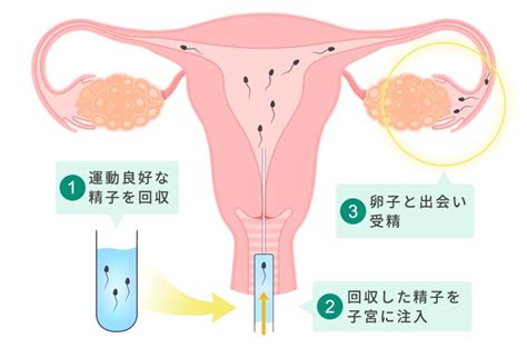 一般不妊治療（タイミング・人工授精） 治療について 【不妊治療専門】第二協立病院artセンター