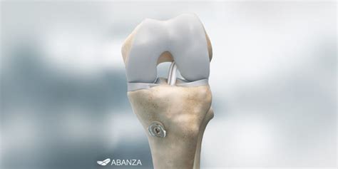 Fda Clears Acl Reconstruction Soft Tissue Fixation System Orthopedics