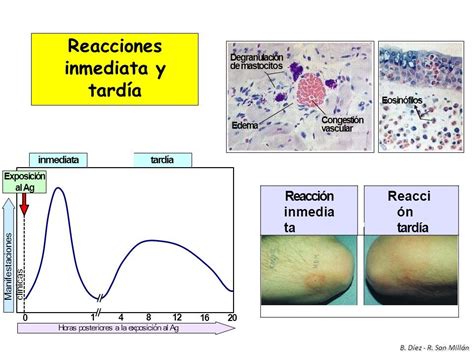 Respuesta Inmune Adaptativa Excesiva O Inadecuada Hipersensibilidad O