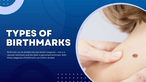 Different Types Of Birthmarks