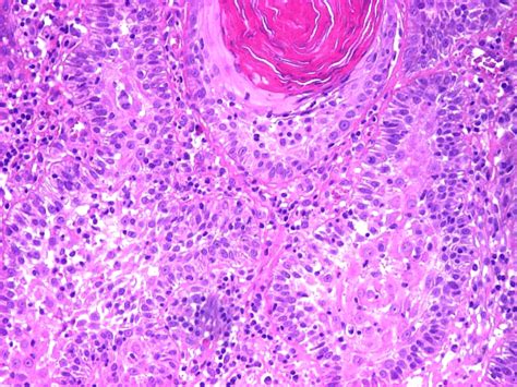 Stroma Containing Many Fibroblasts And Inflammatory Cells Lymphocytes Download Scientific