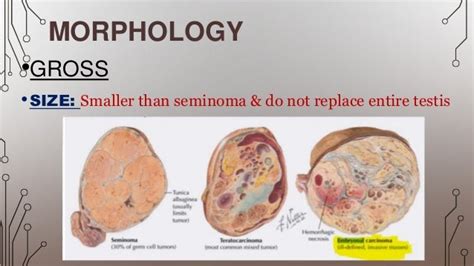 embryonal carcinoma