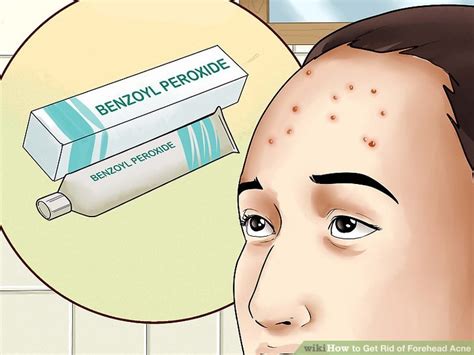 4 Ways To Get Rid Of Forehead Acne Wikihow