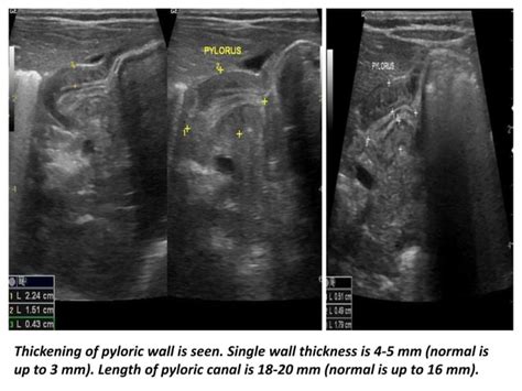 Presentation1 Radiological Imaging Of Hypertrophic Pyloric Stenosis