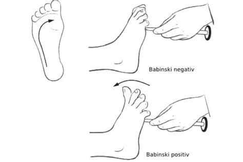 What Is The Babinski Reflex